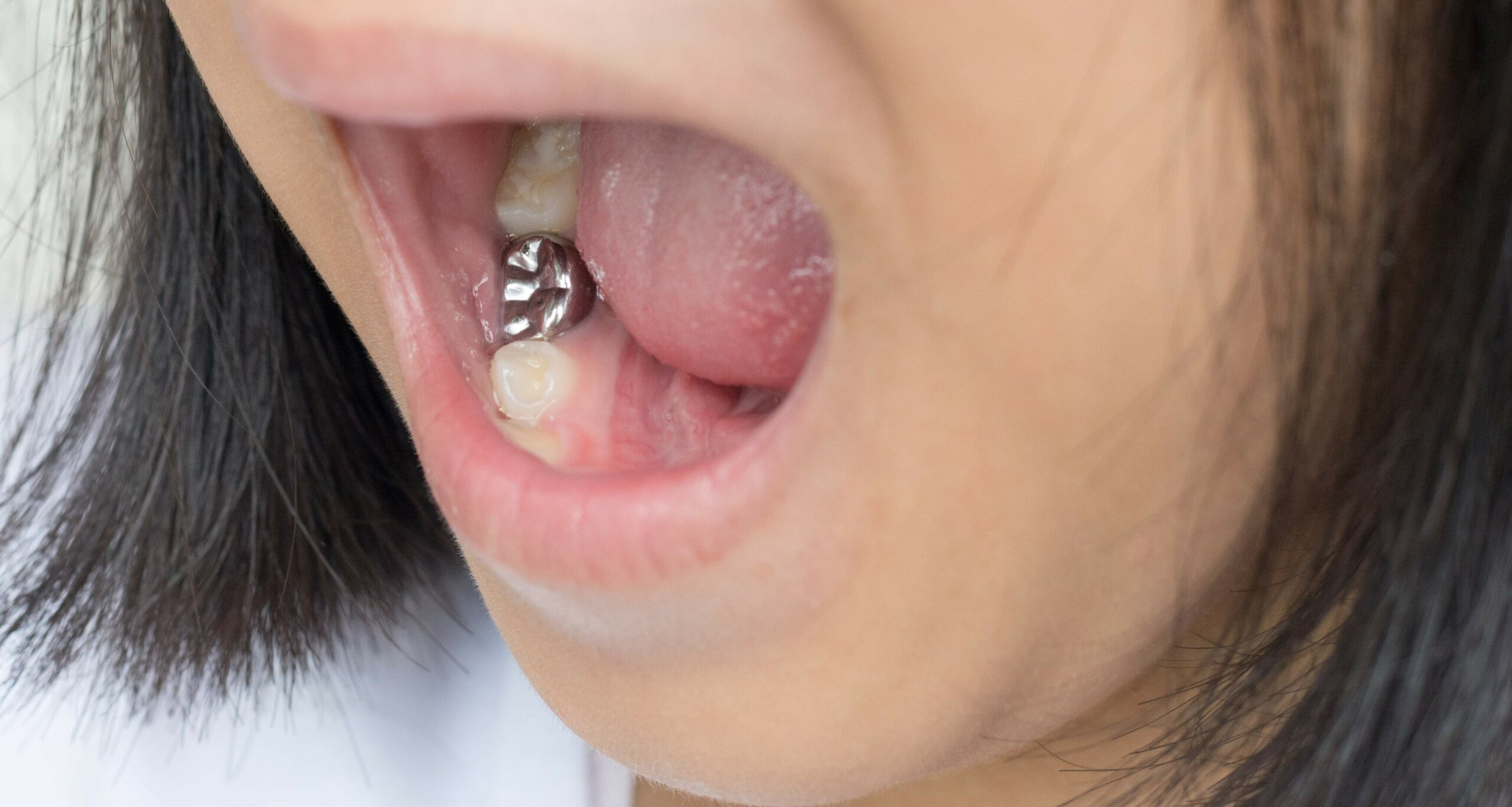 Why Do Kids Get Silver Teeth? | Pediatric Smiles Dentistry, image size:2560x1366